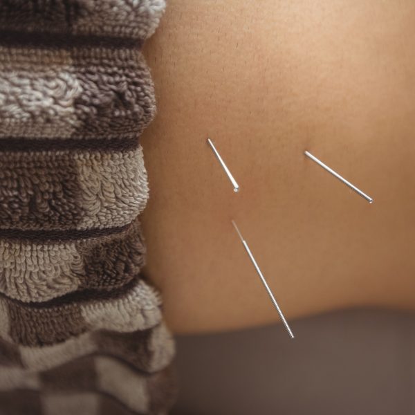 close-up-of-a-patient-getting-dry-needling close-up-of-a-patient-getting-dry-needling